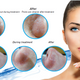 NÝTT- AquaGlo plus™ Abrasion-Free Hydra Peeling Liquid Facial System